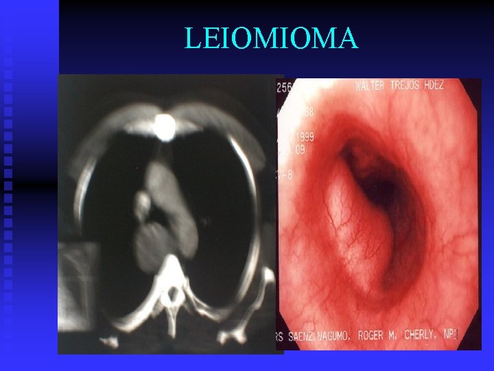 LEIOMIOMA 