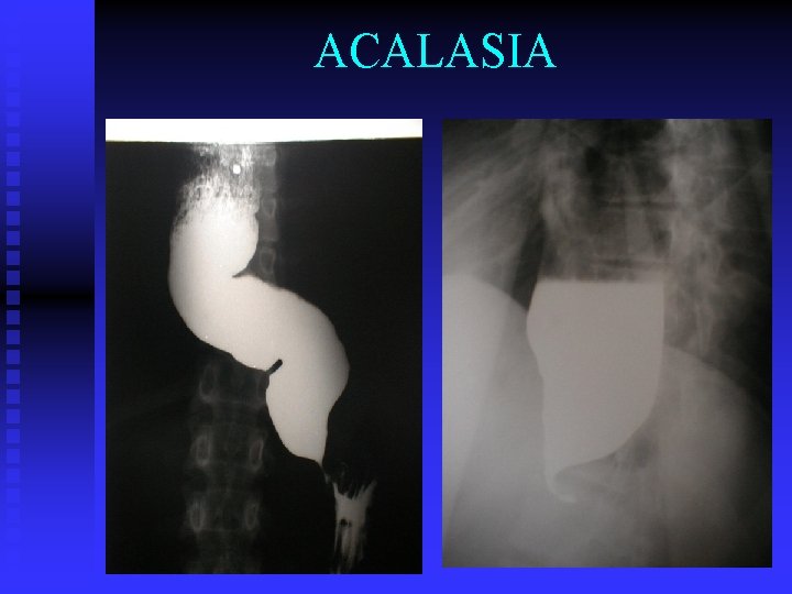 ACALASIA 