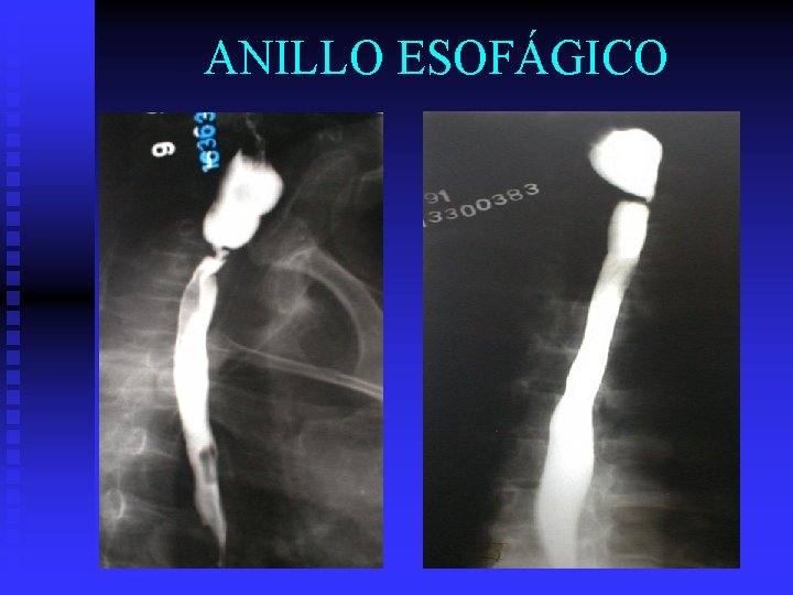 ANILLO ESOFÁGICO 