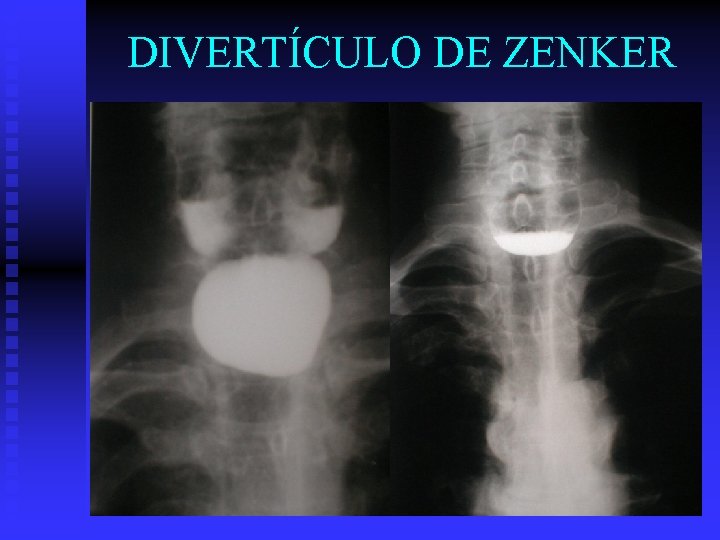 DIVERTÍCULO DE ZENKER 