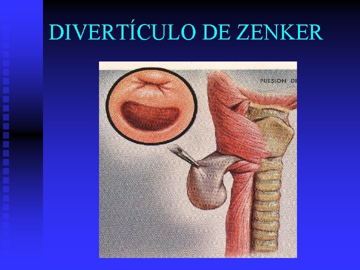 DIVERTÍCULO DE ZENKER 