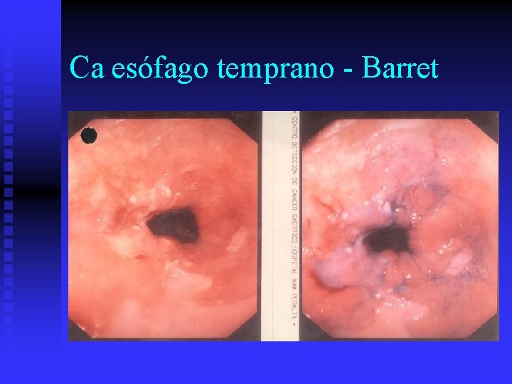 Ca esófago temprano - Barret 