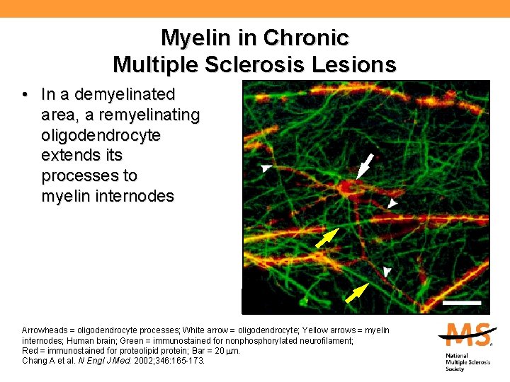 Myelin in Chronic Multiple Sclerosis Lesions • In a demyelinated area, a remyelinating oligodendrocyte