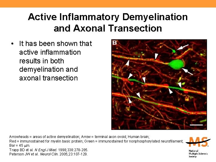Active Inflammatory Demyelination and Axonal Transection • It has been shown that active inflammation