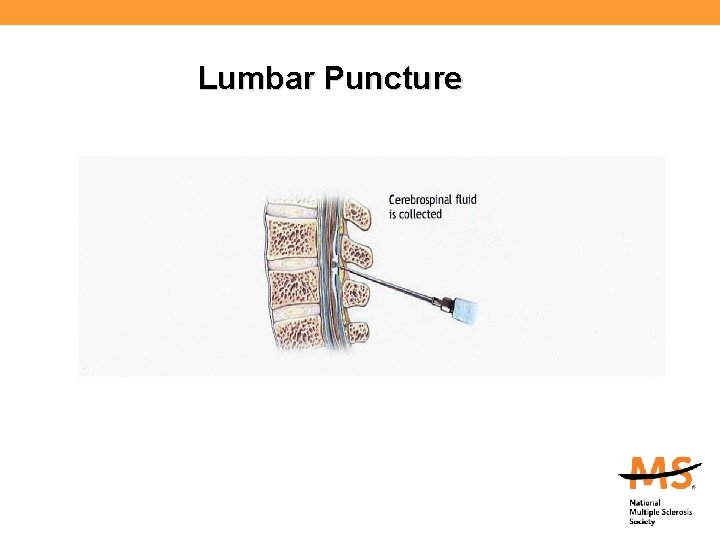 Lumbar Puncture 