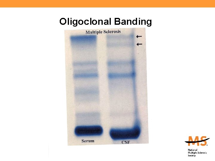 Oligoclonal Banding 