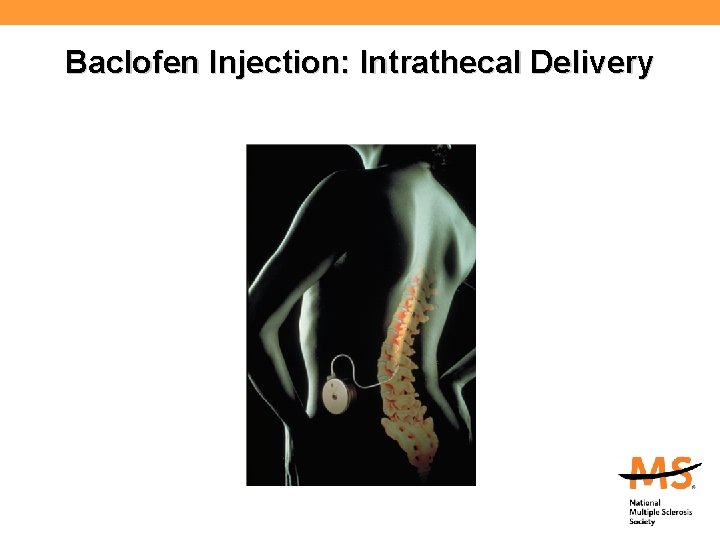 Baclofen Injection: Intrathecal Delivery 