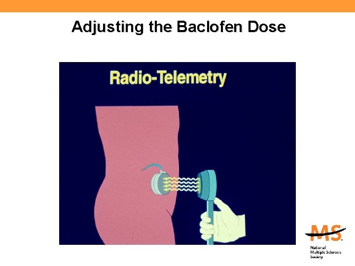 Adjusting the Baclofen Dose 