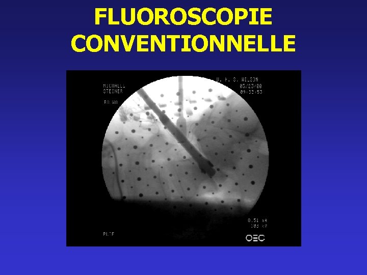 FLUOROSCOPIE CONVENTIONNELLE 