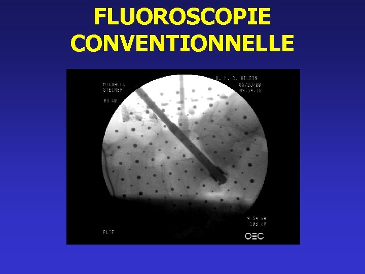 FLUOROSCOPIE CONVENTIONNELLE 