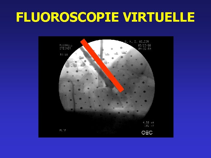 FLUOROSCOPIE VIRTUELLE 