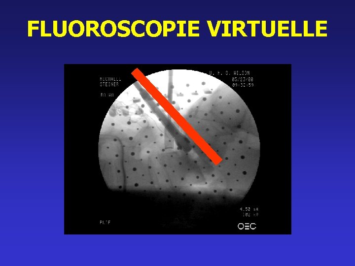 FLUOROSCOPIE VIRTUELLE 