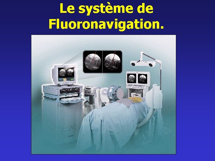 Le système de Fluoronavigation. 