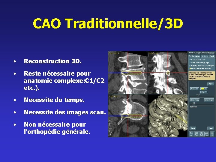 CAO Traditionnelle/3 D • Reconstruction 3 D. • Reste nécessaire pour anatomie complexe: C