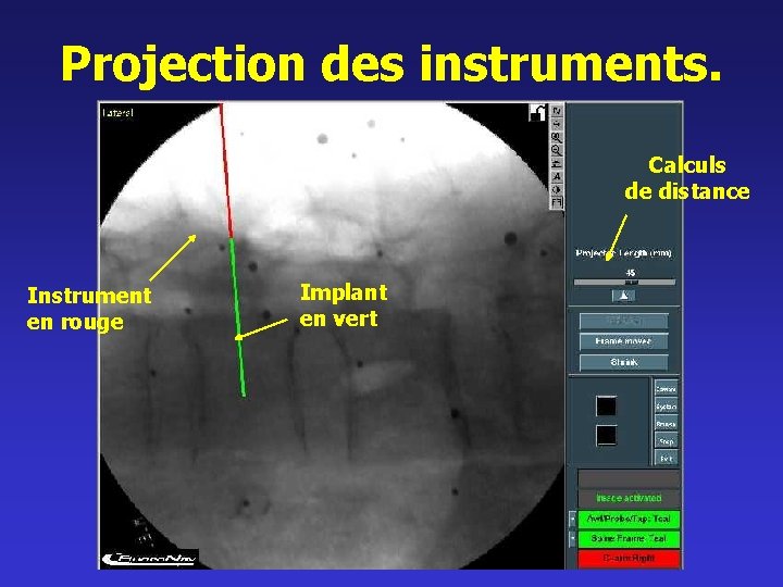 Projection des instruments. Calculs de distance Instrument en rouge Implant en vert 