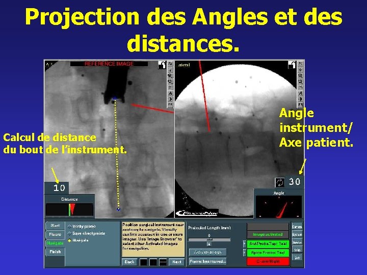 Projection des Angles et des distances. Calcul de distance du bout de l’instrument. Angle