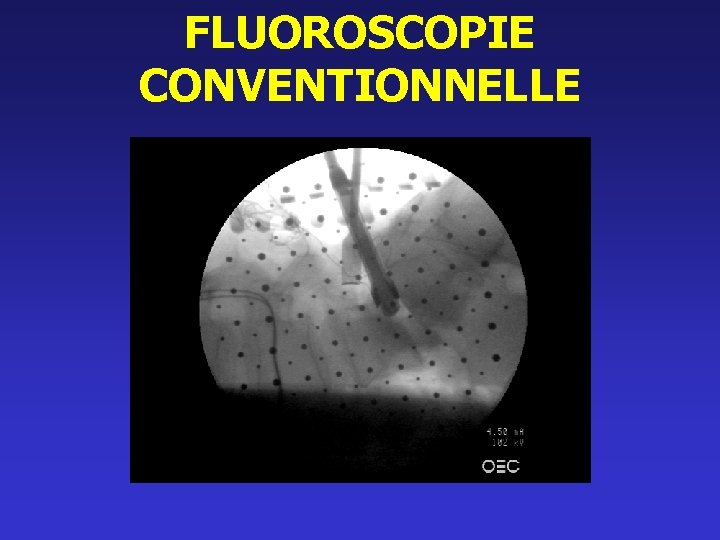 FLUOROSCOPIE CONVENTIONNELLE 