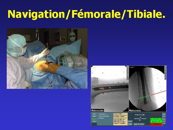 Navigation/Fémorale/Tibiale. 