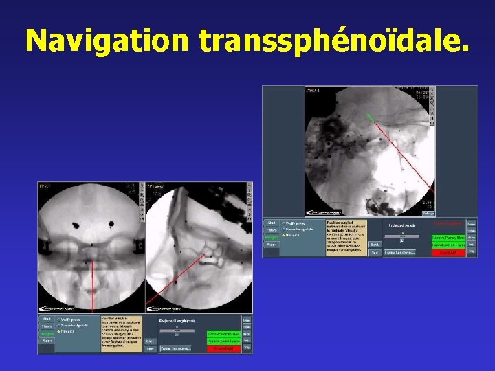 Navigation transsphénoïdale. 