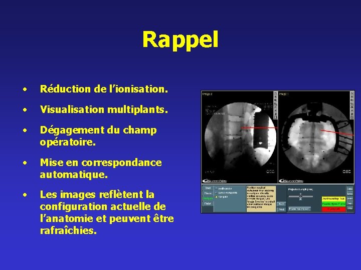 Rappel • Réduction de l’ionisation. • Visualisation multiplants. • Dégagement du champ opératoire. •