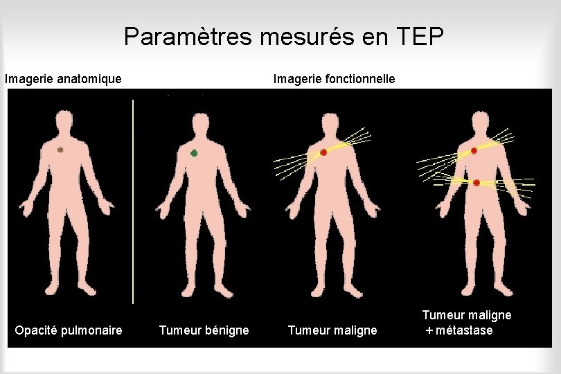Paramètres mesurés en TEP Imagerie anatomique Opacité pulmonaire Imagerie fonctionnelle Tumeur bénigne Tumeur maligne