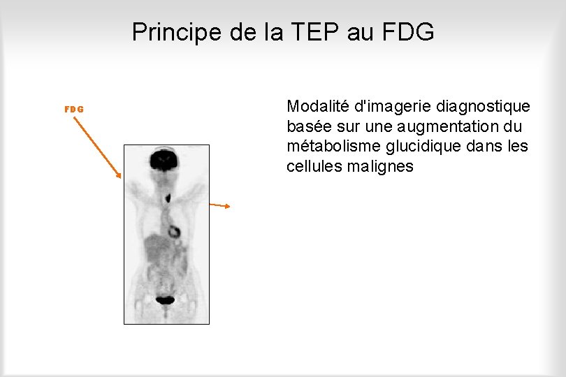 Principe de la TEP au FDG Modalité d'imagerie diagnostique basée sur une augmentation du
