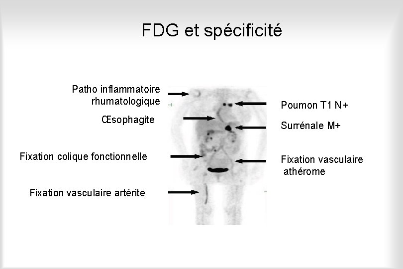 FDG et spécificité Patho inflammatoire rhumatologique Œsophagite Fixation colique fonctionnelle Fixation vasculaire artérite Poumon