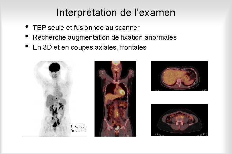 Interprétation de l’examen • • • TEP seule et fusionnée au scanner Recherche augmentation