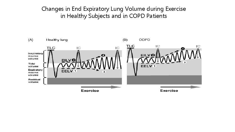 Changes in End Expiratory Lung Volume during Exercise in Healthy Subjects and in COPD