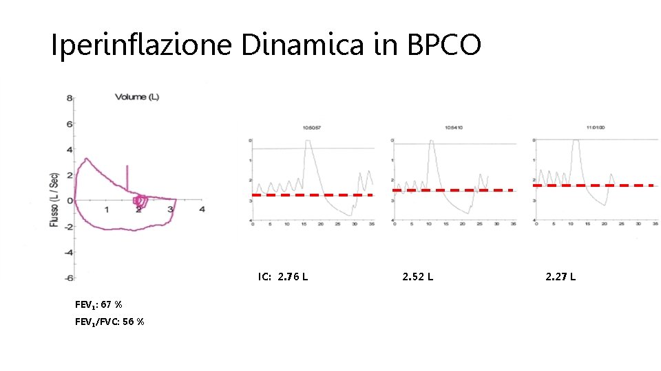 Iperinflazione Dinamica in BPCO IC: 2. 76 L FEV 1: 67 % FEV 1/FVC: