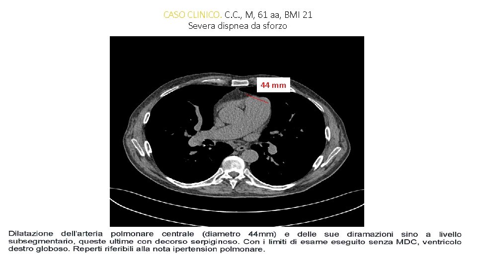 CASO CLINICO. C. C. , M, 61 aa, BMI 21 Severa dispnea da sforzo