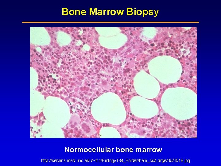 Bone Marrow Biopsy Normocellular bone marrow http: //serpins. med. unc. edu/~fcc/Biology 134_Folder/hem_cd/Large/05/0518. jpg Bone Marrow Biopsy Normocellular bone marrow http: //serpins. med. unc. edu/~fcc/Biology 134_Folder/hem_cd/Large/05/0518. jpg