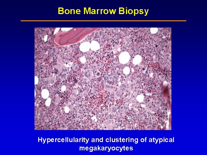 Bone Marrow Biopsy Hypercellularity and clustering of atypical megakaryocytes Bone Marrow Biopsy Hypercellularity and clustering of atypical megakaryocytes