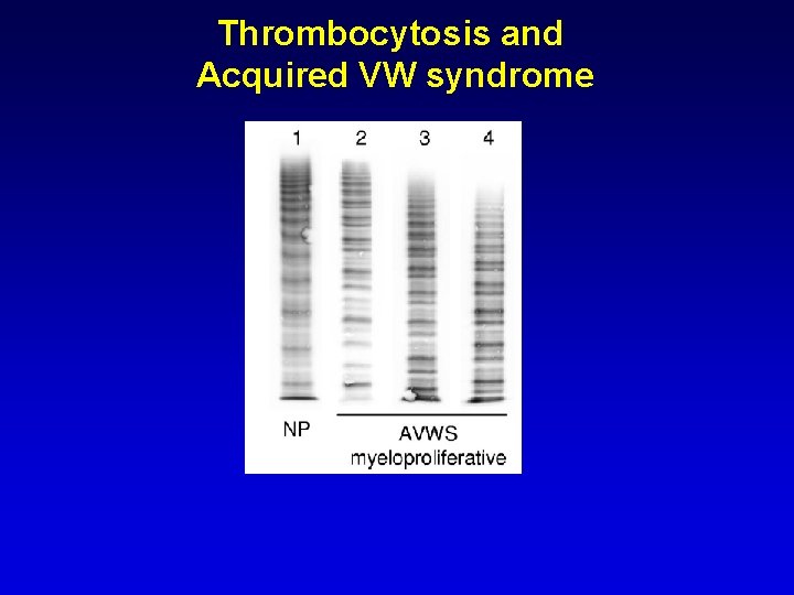 Thrombocytosis and Acquired VW syndrome Thrombocytosis and Acquired VW syndrome