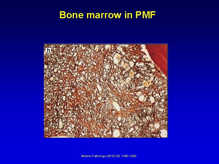 Bone marrow in PMF Modern Pathology (2012) 25, 1193– 1202 Bone marrow in PMF Modern Pathology (2012) 25, 1193– 1202