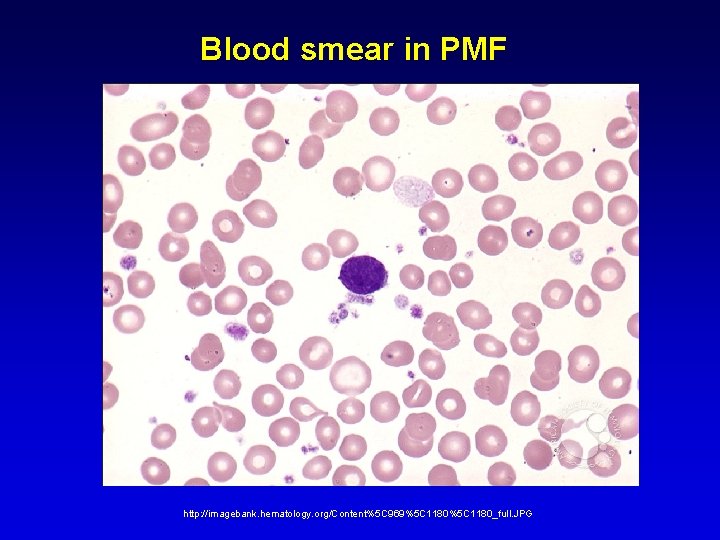 Blood smear in PMF http: //imagebank. hematology. org/Content%5 C 969%5 C 1180_full. JPG Blood smear in PMF http: //imagebank. hematology. org/Content%5 C 969%5 C 1180_full. JPG