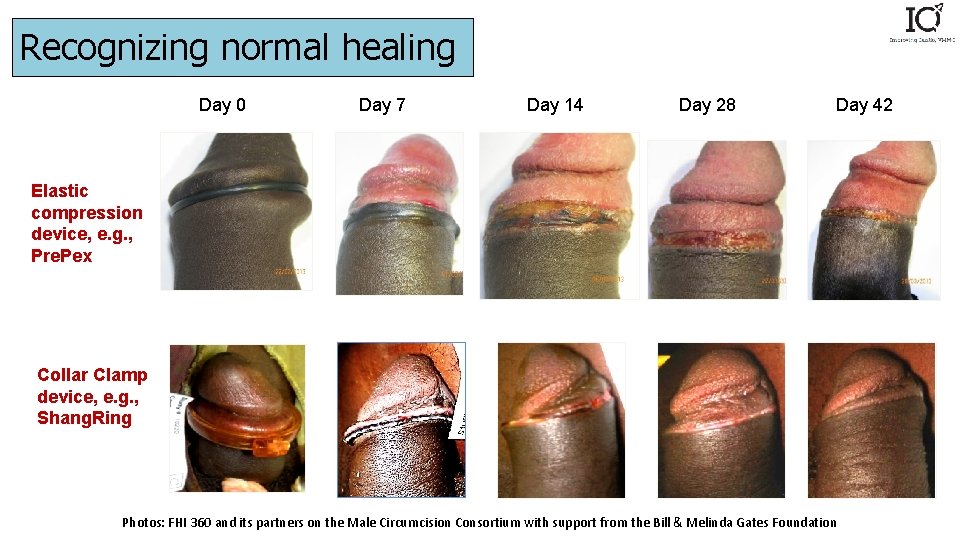 Recognizing normal healing Day 0 Day 7 Day 14 Day 28 Day 42 Elastic