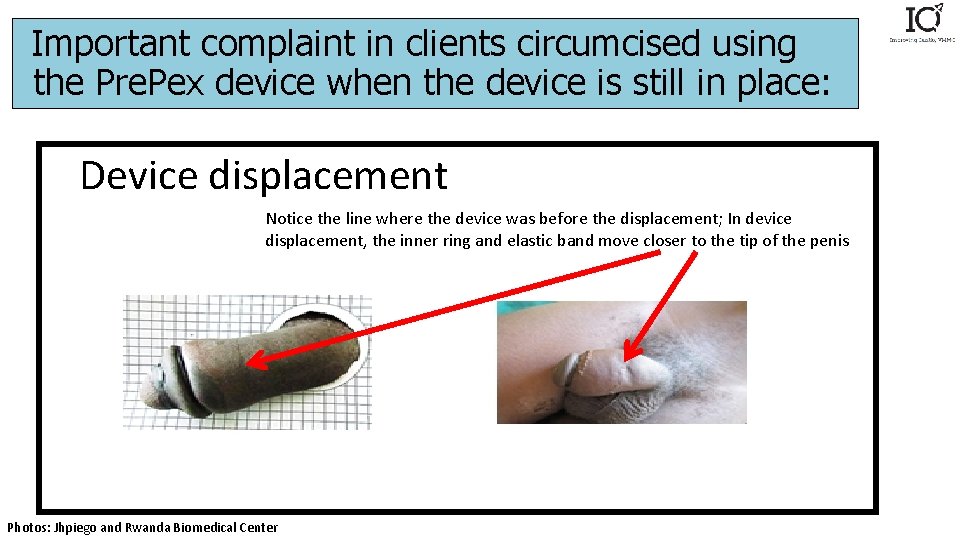 Important complaint in clients circumcised using the Pre. Pex device when the device is