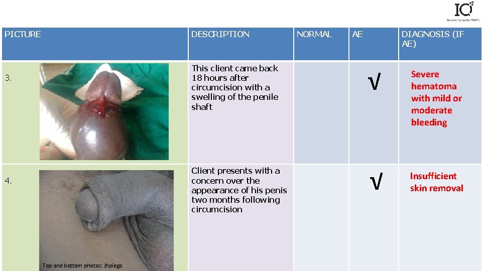 PICTURE DESCRIPTION 3. 4. Top and bottom photos: Jhpiego NORMAL AE DIAGNOSIS (IF AE)