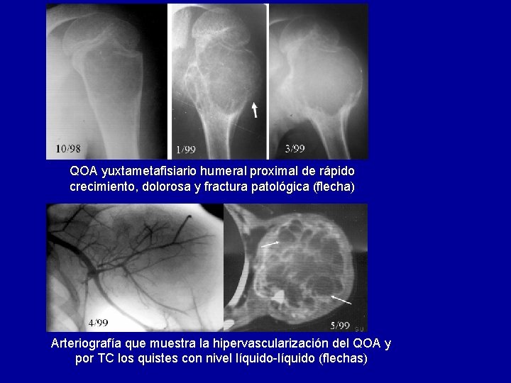 QOA yuxtametafisiario humeral proximal de rápido crecimiento, dolorosa y fractura patológica (flecha) Arteriografía que