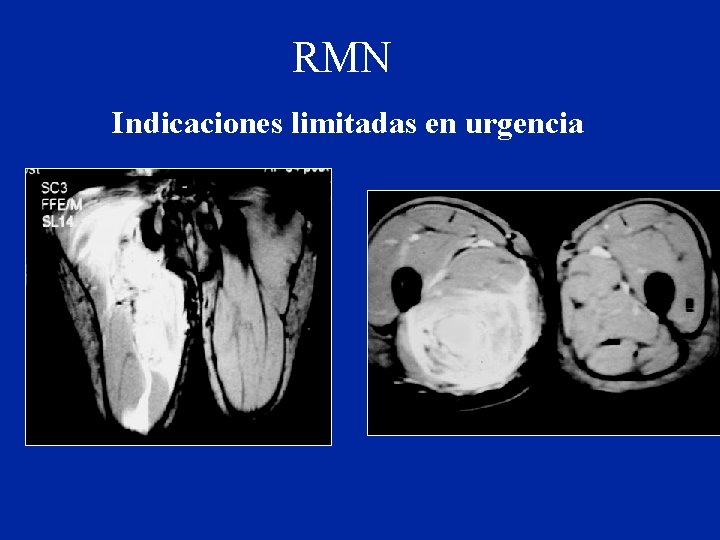 RMN Indicaciones limitadas en urgencia 