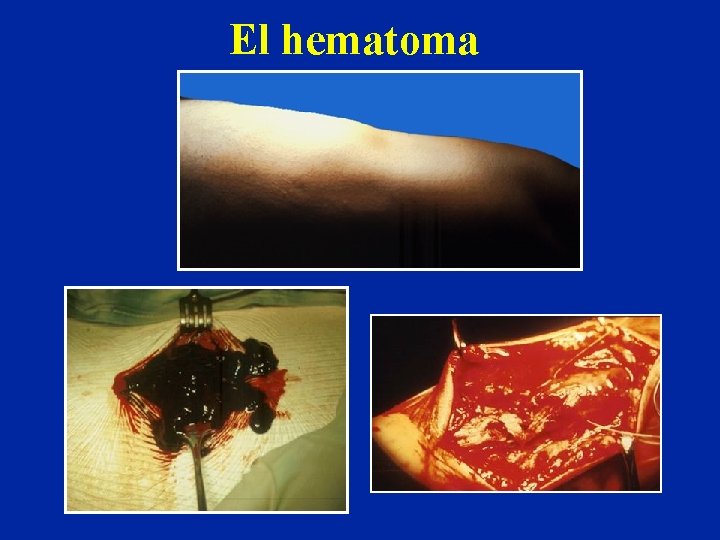 El hematoma 