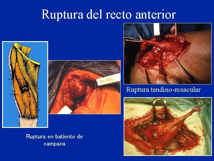 Ruptura del recto anterior Ruptura tendino-muscular Ruptura en batiente de campana 