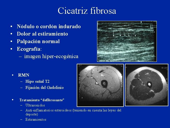 Cicatriz fibrosa • • Nódulo o cordón indurado Dolor al estiramiento Palpación normal Ecografía: