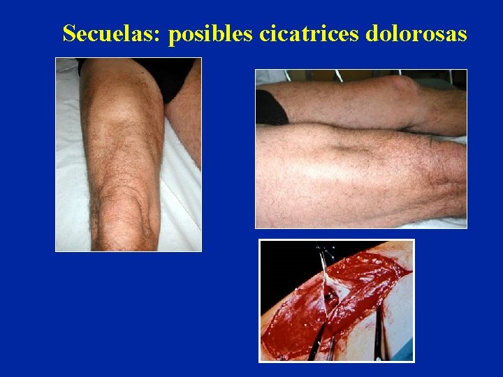 Secuelas: posibles cicatrices dolorosas 