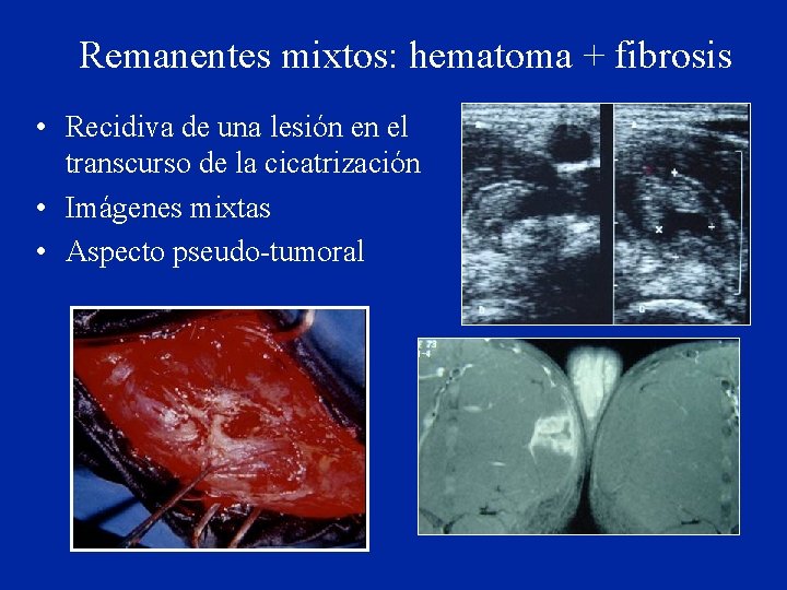 Remanentes mixtos: hematoma + fibrosis • Recidiva de una lesión en el transcurso de