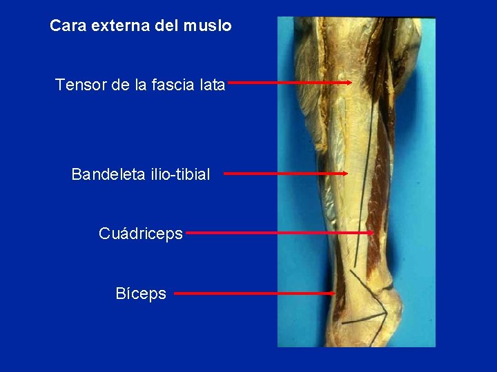 Cara externa del muslo Tensor de la fascia lata Bandeleta ilio-tibial Cuádriceps Bíceps 