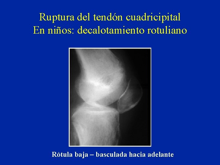 Ruptura del tendón cuadricipital En niños: decalotamiento rotuliano Rótula baja – basculada hacia adelante