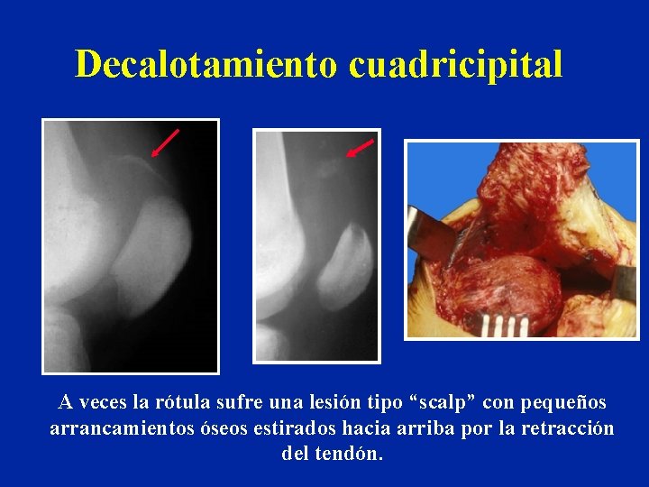 Decalotamiento cuadricipital A veces la rótula sufre una lesión tipo “scalp” con pequeños arrancamientos