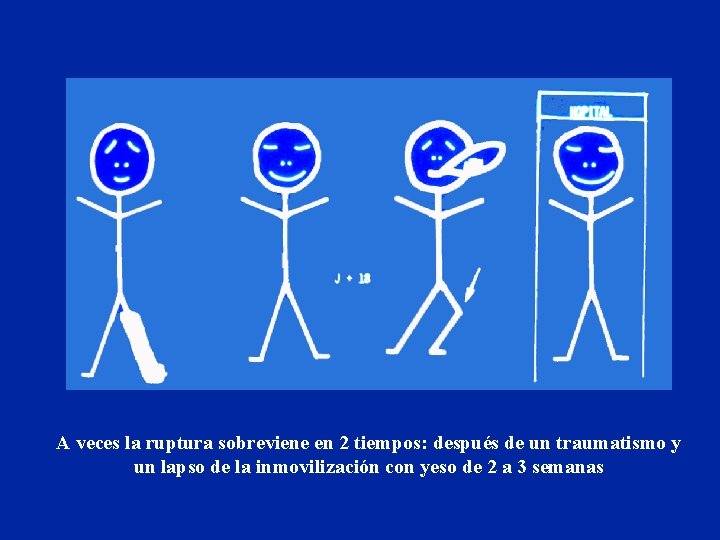 A veces la ruptura sobreviene en 2 tiempos: después de un traumatismo y un